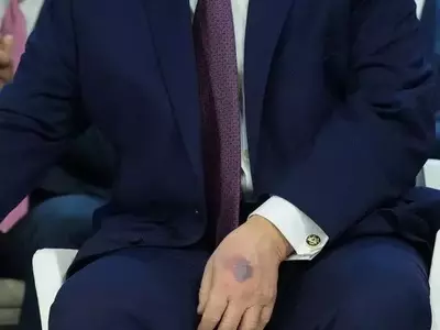 Trump Explains Hand Bruise Amid Health Speculation