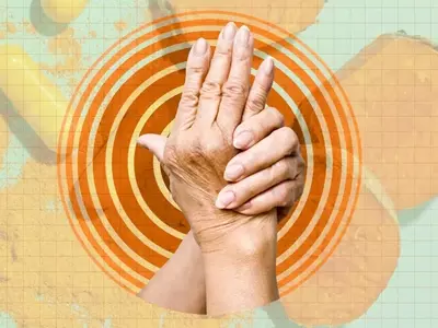 Dietary Strategies to Mitigate Arthritis Flare-Ups