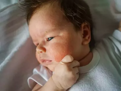 Common Rashes in Children: Identification and Management