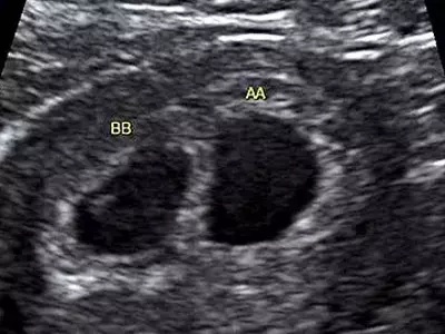 A Journey Through Twin Pregnancy: Ultrasound Milestones