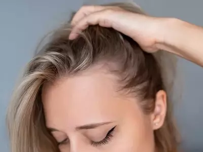 Veradermics: Pioneer in Pattern Hair Loss Treatment with Promising Oral Minoxidil